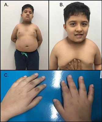 First Case Report of Prader–Willi-Like Syndrome in Colombia